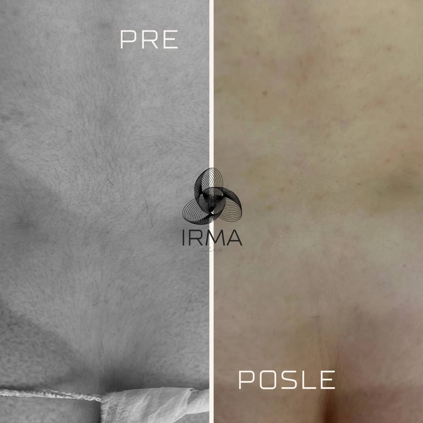 Donji deo leđa pre i posle laserske epilacije