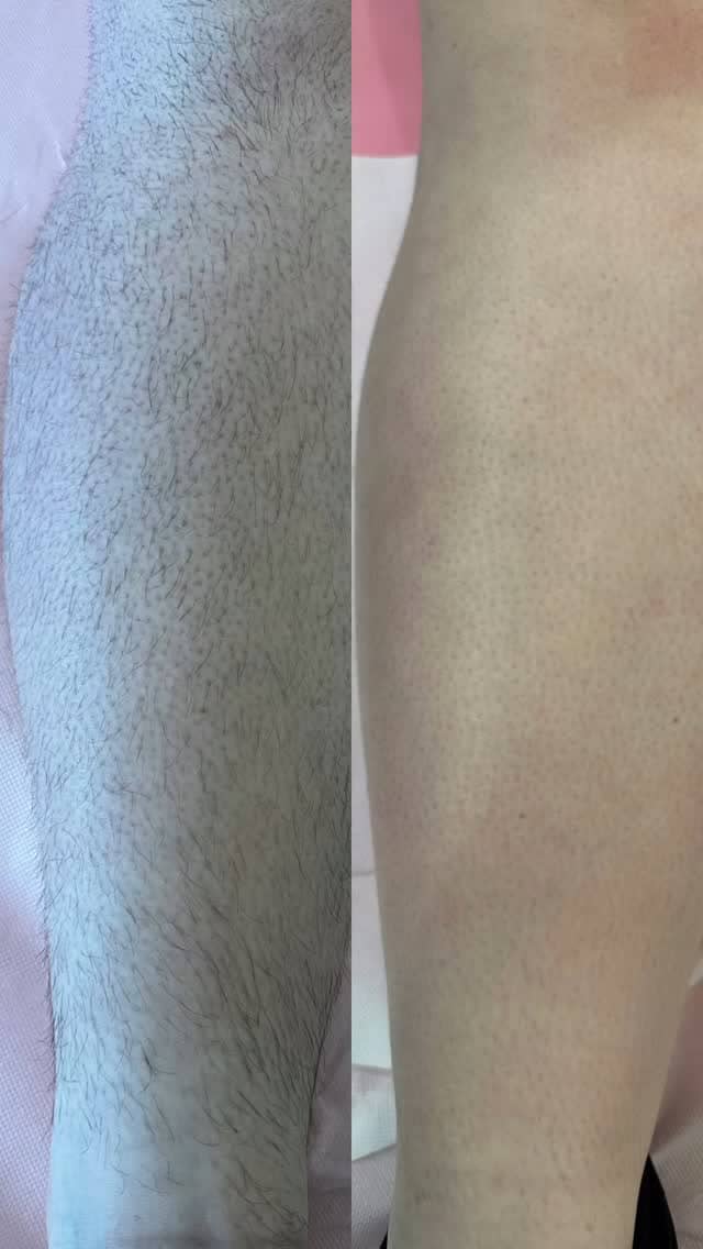 Noga pre (levo) i posle (desno) laserske epilacije