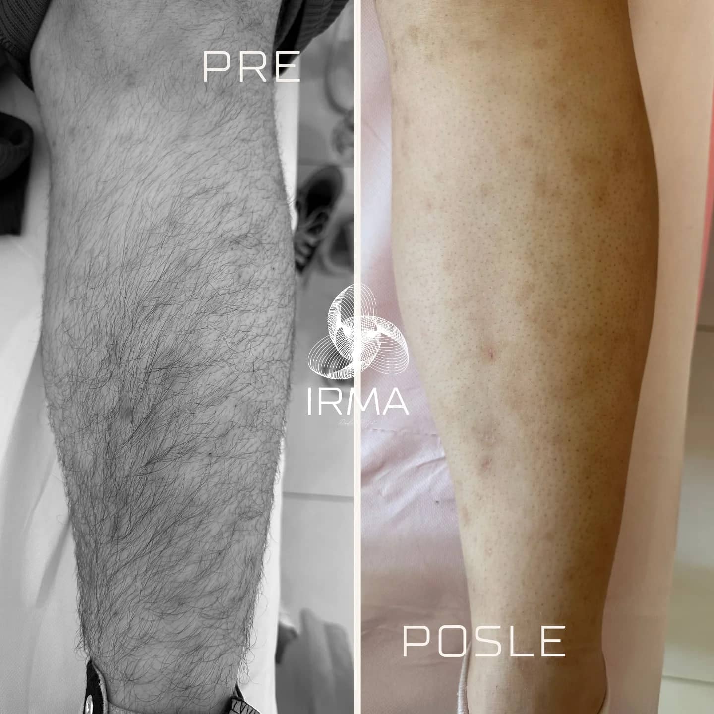 Noge pre i posle laserske epilacije