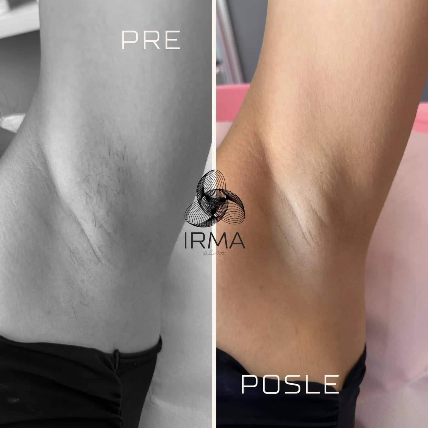 Pazuh pre i posle laserske epilacije, drugi primer