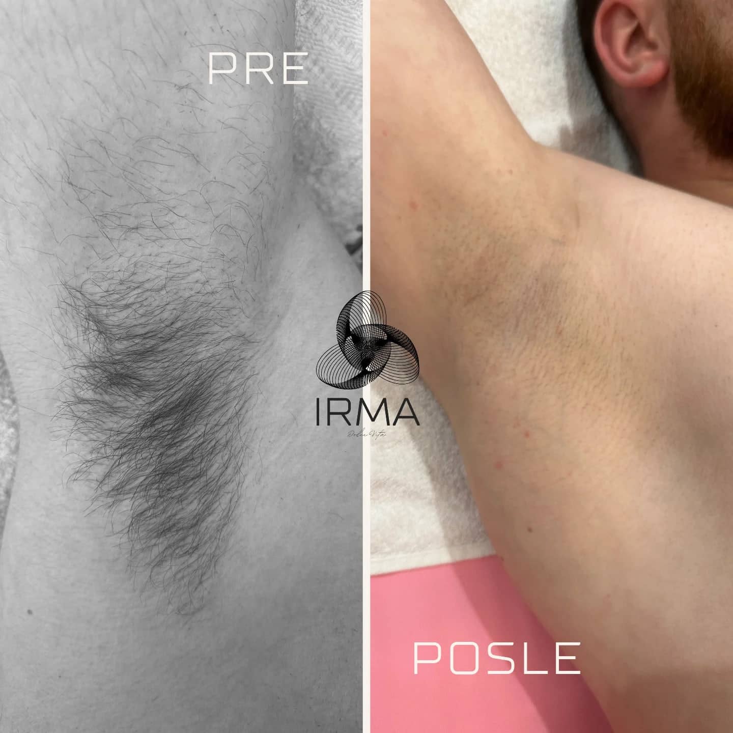 Muški pazuh pre i posle laserske epilacije