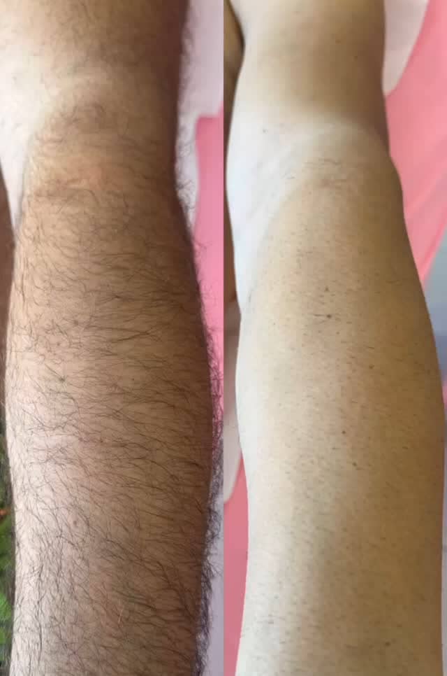 Podlaktica pre (levo) i posle (desno) laserske epilacije