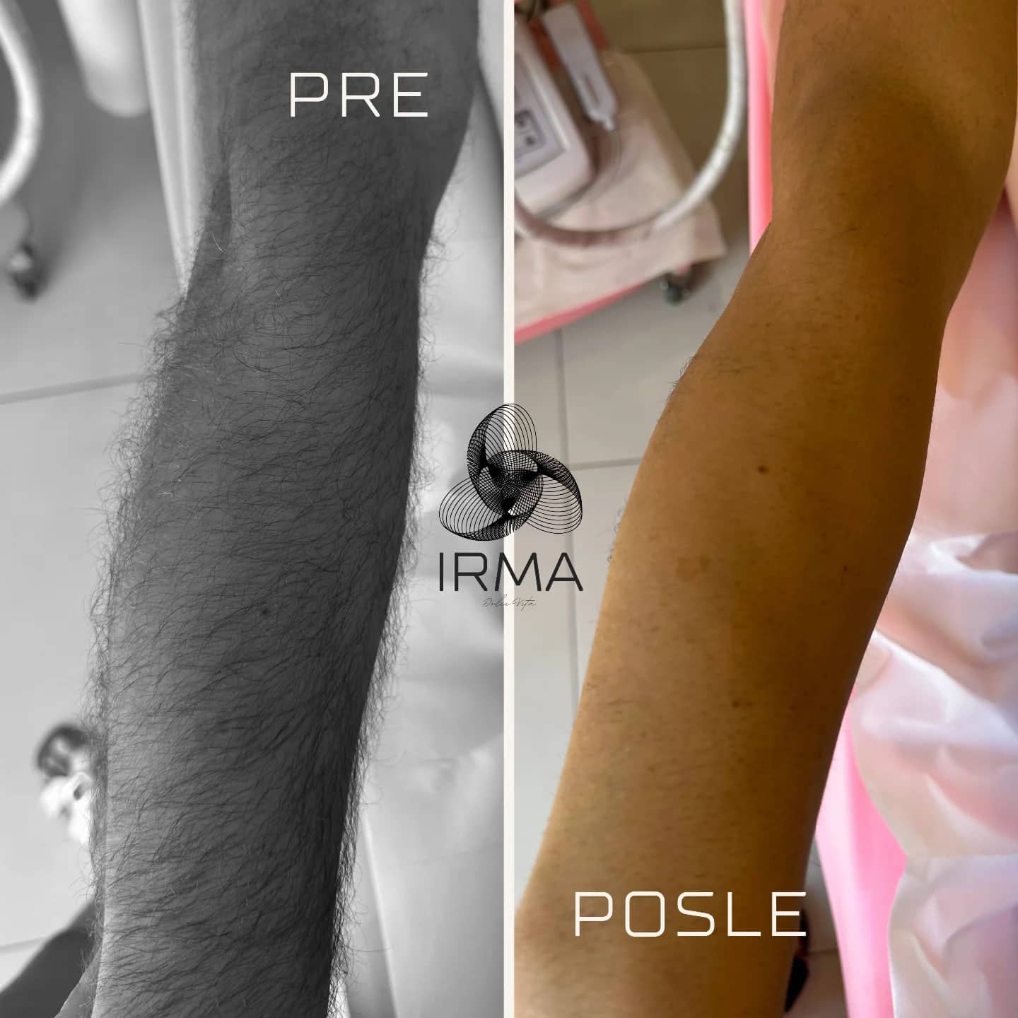 Ruka pre i posle laserske epilacije